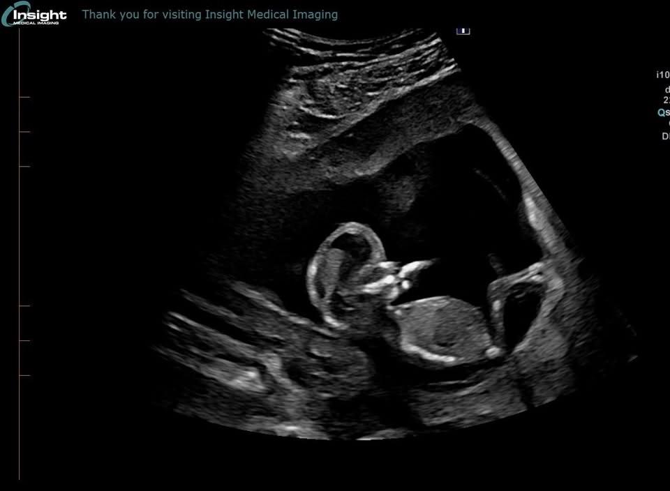 π©΅π©· Gender Reveal π©·π©΅
