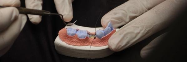 ATRAUMATIC EXTRACTION AND RIDGE PRESERVATION