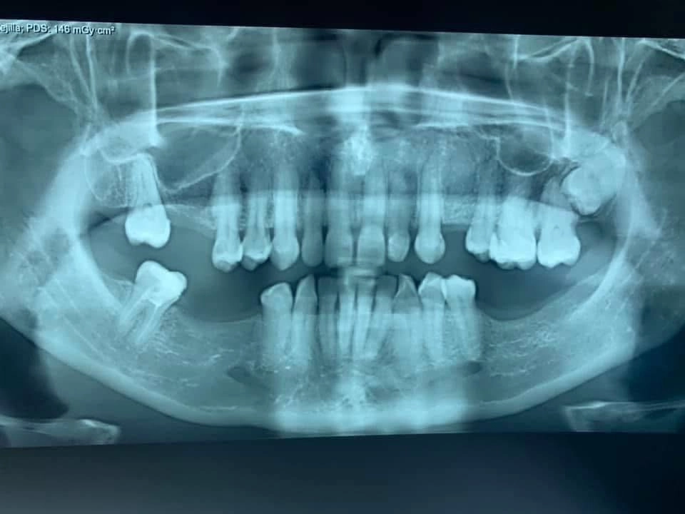Campaña de Implantes en Cañete